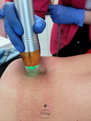 Frakcjonowanie mikroigłowe RF