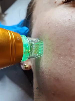 Frakcjonowanie mikroigłowe RF