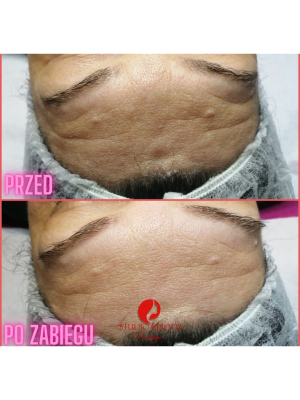 Mezoterapia mikroigłowa 