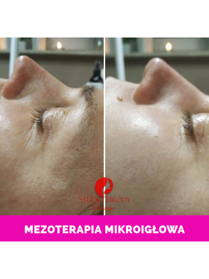 Mezoterapia mikroigłowa 