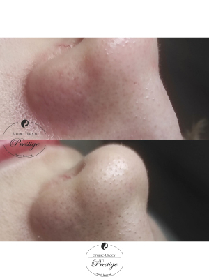 Mikrodermabrazja + maska