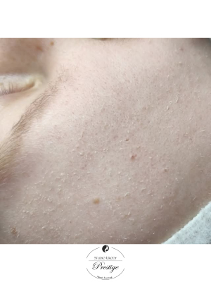 Mikrodermabrazja + maska