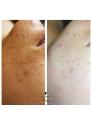 Oczyszczanie wodorowe w terapii łączonej