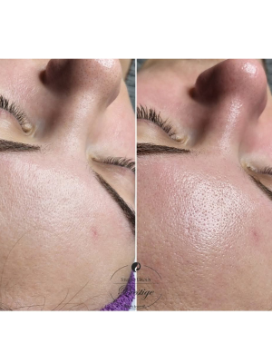 Oczyszczanie wodorowe z maską