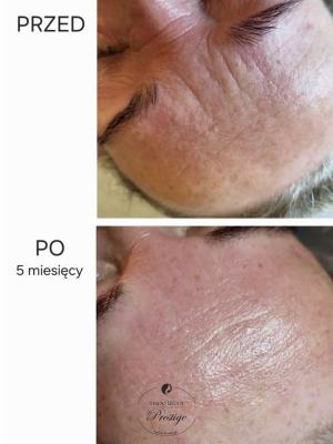 Frakcjonowanie mikroigłowe RF