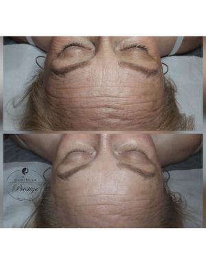 Zabieg liftingujący Sekret wiecznej młodości