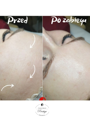 Zabieg liftingujący Sekret wiecznej młodości