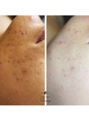 Redness Minimizers Therapy Program