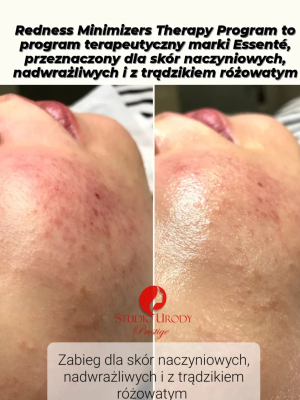 Redness Minimizers Therapy Program