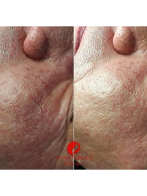 Redness Minimizers Therapy Program